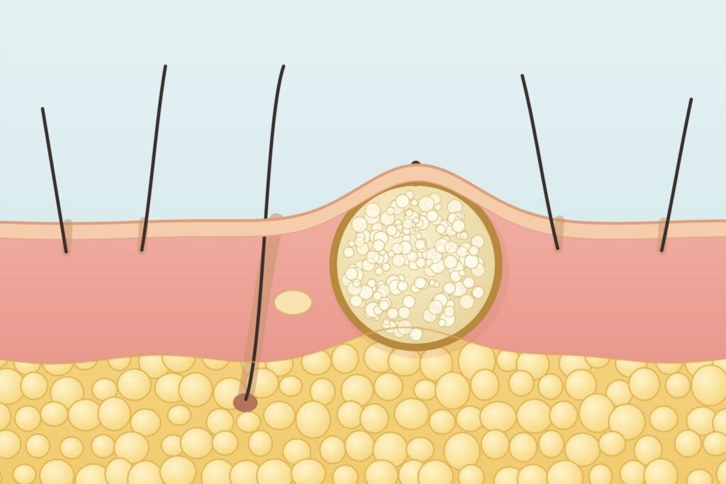 Illustration: Atherom als Zyste unter der Haut im Querschnitt