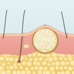 Illustration: Atherom als Zyste unter der Haut im Querschnitt