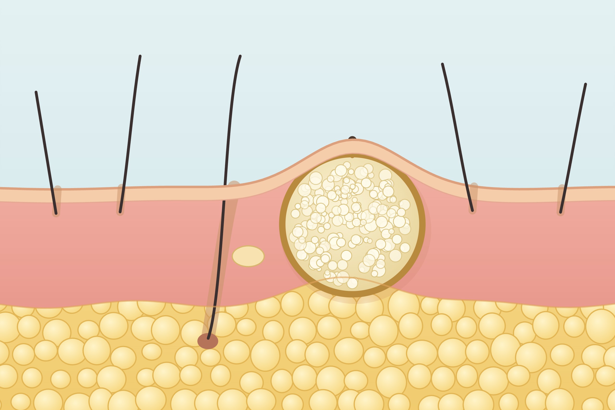 Illustration: Atherom als Zyste unter der Haut im Querschnitt