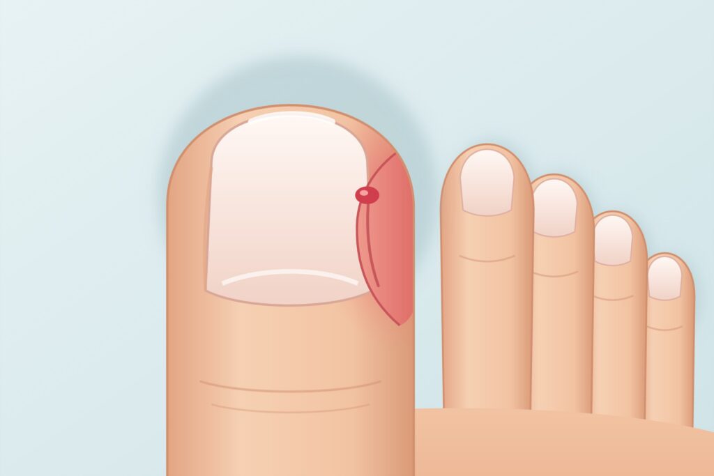 Illustration: eingewachsener und entzündeter Zehennagel