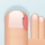 Illustration: eingewachsener und entzündeter Zehennagel