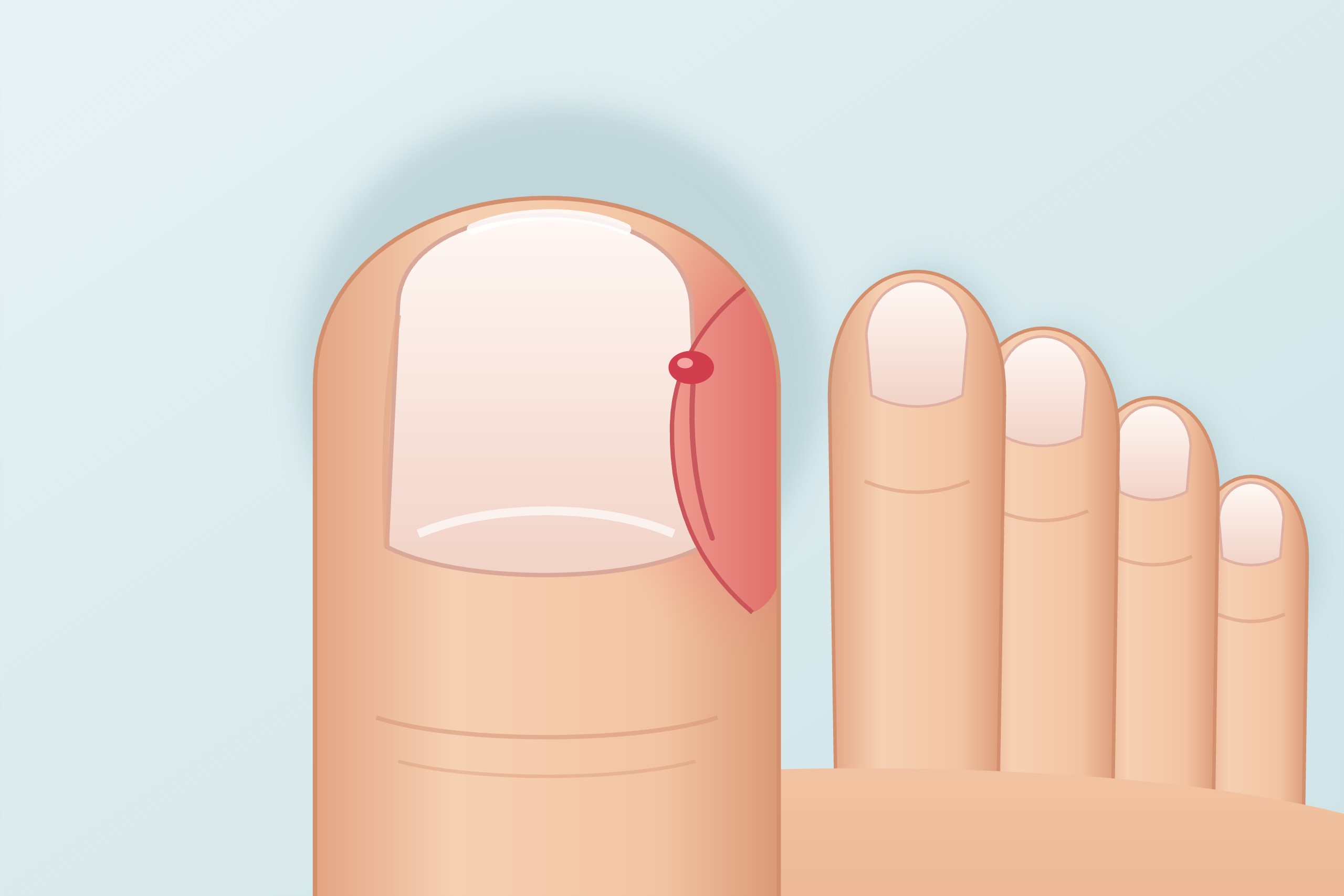 Illustration: eingewachsener und entzündeter Zehennagel