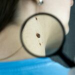 Untersuchung eines Muttermals mit der Lupe